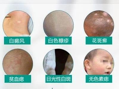 白斑症状的疾病